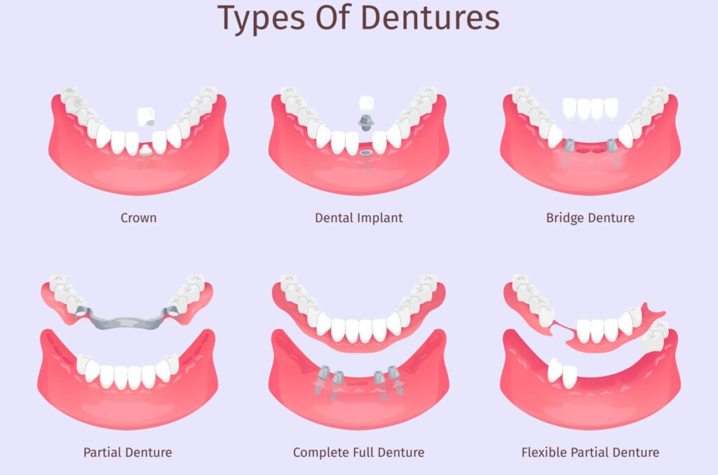 A diagram showing how different kinds of dentures and implants fit into the mouth.