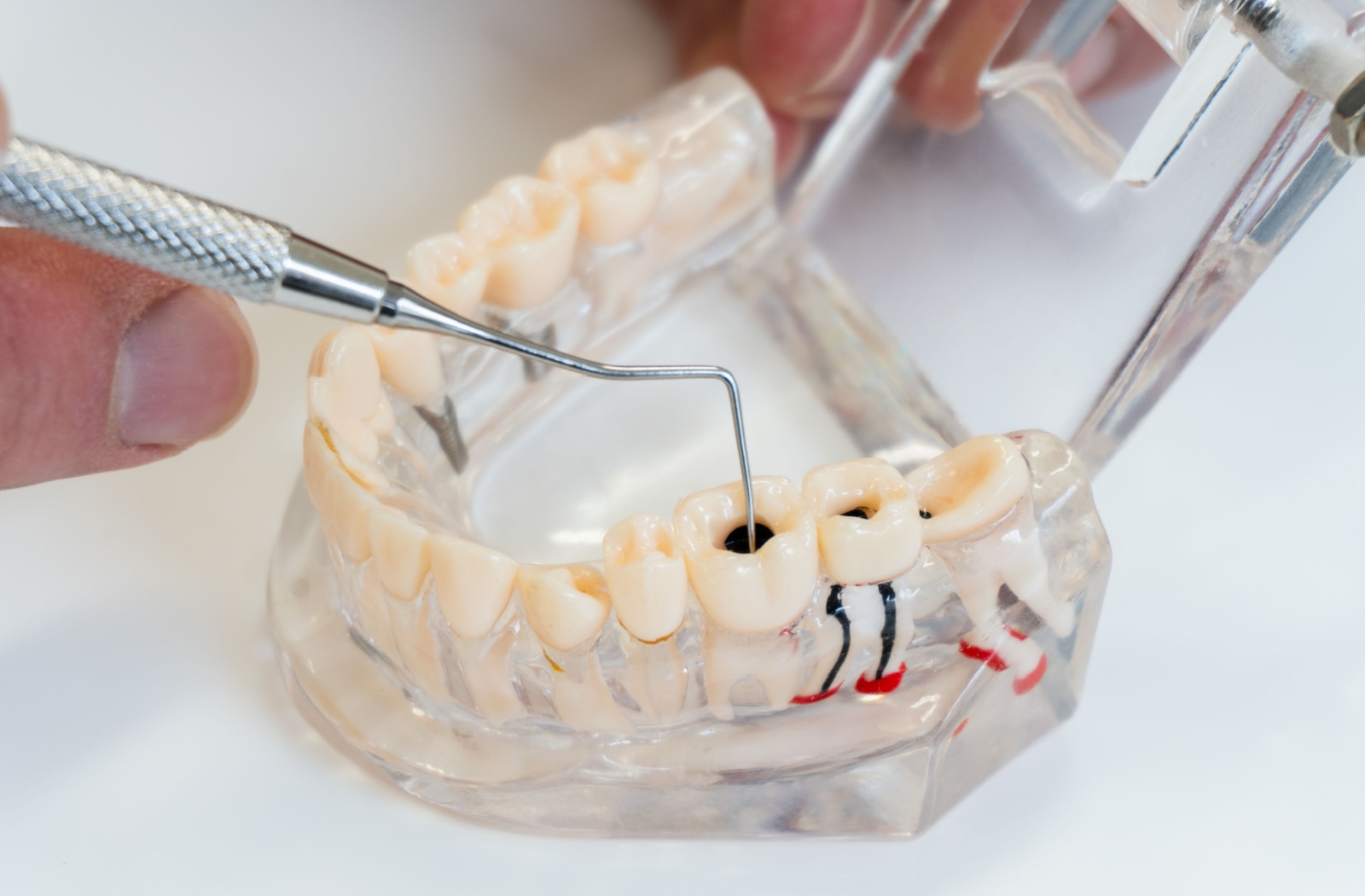 A close-up model of a jaw showing how a tooth infection creates a need for a root canal.