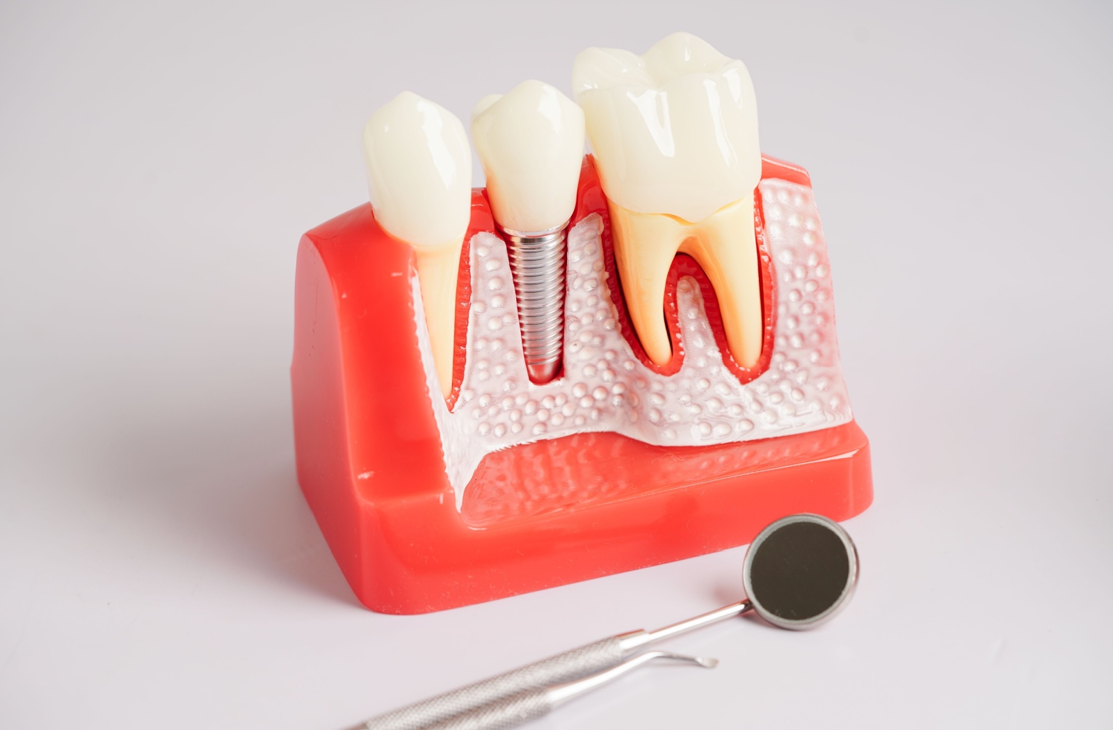 A dental implant model rests against a white background.